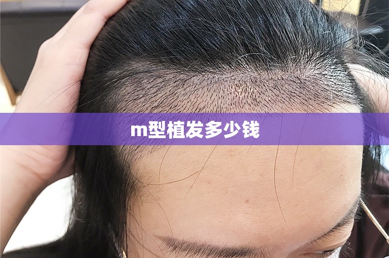 m型植发多少钱