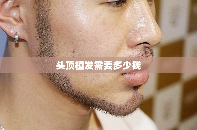 头顶植发需要多少钱