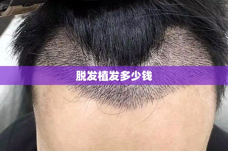 脱发植发多少钱 脱发植发多少钱