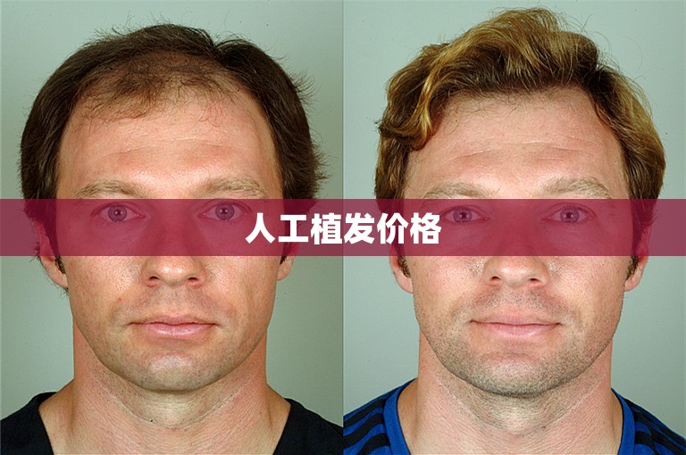 人工植发价格