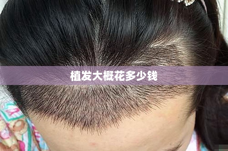 植发大概花多少钱