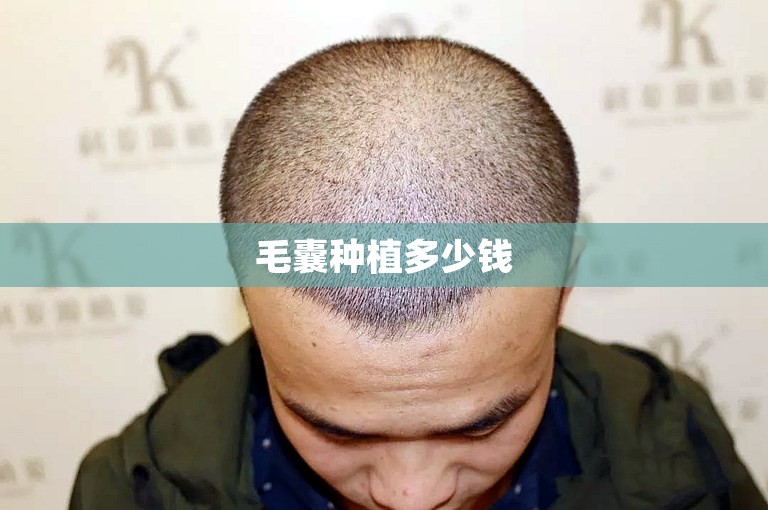 毛囊种植多少钱