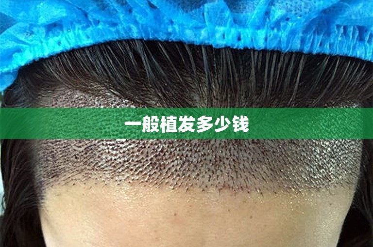一般植发多少钱