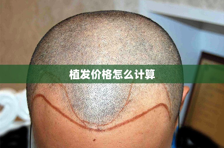 植发价格怎么计算