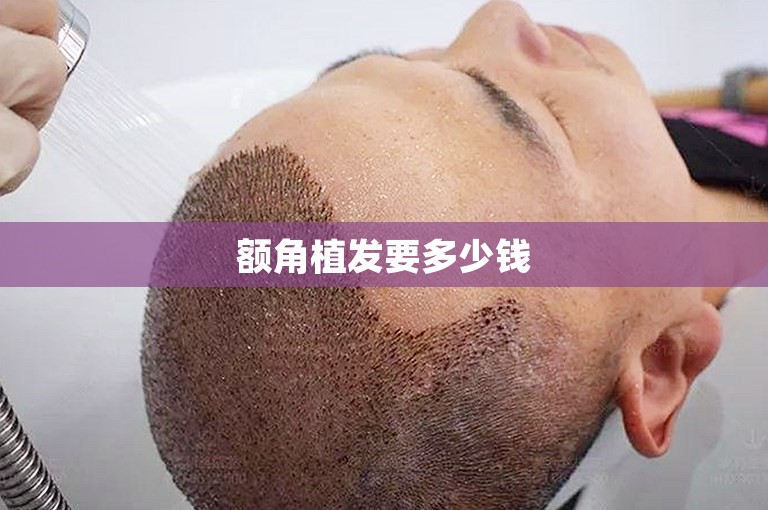 额角植发要多少钱 额角植发要多少钱