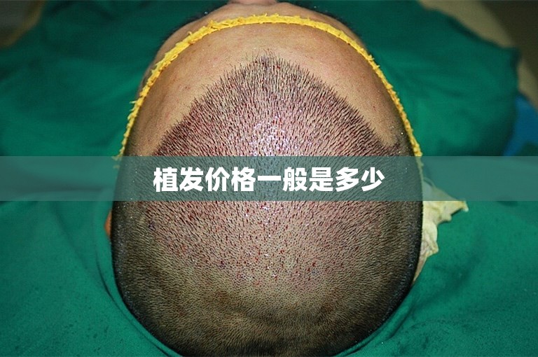 植发价格一般是多少