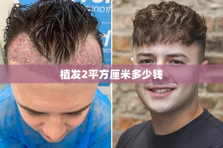 植发2平方厘米多少钱
