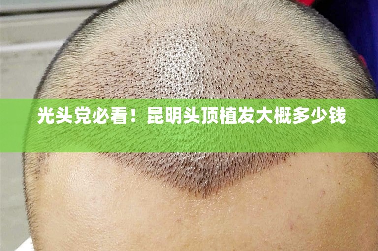 光头党必看!昆明头顶植发大概多少钱 光头党必看!昆明头顶植发大概多少钱