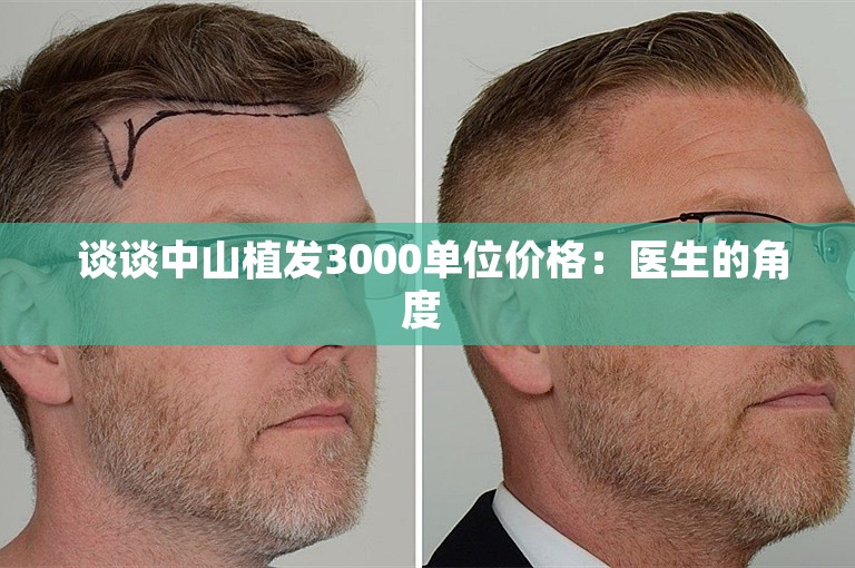 谈谈中山植发3000单位价格:医生的角度 谈谈中山植发3000单位价格:医生的角度