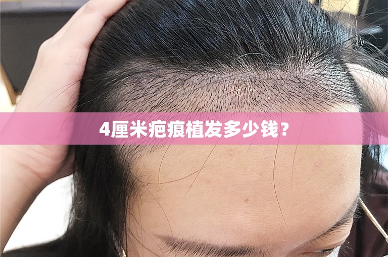 4厘米疤痕植发多少钱? 4厘米疤痕植发多少钱?