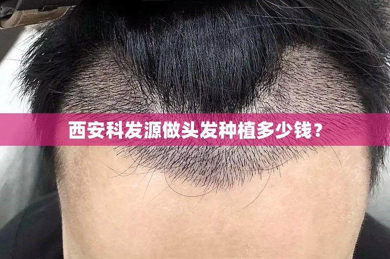 西安科发源做头发种植多少钱？
