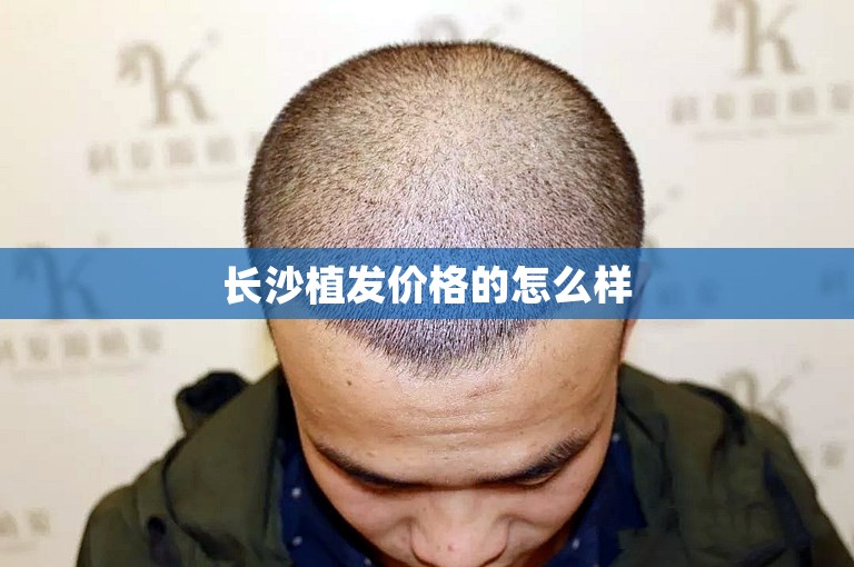 长沙植发价格的怎么样