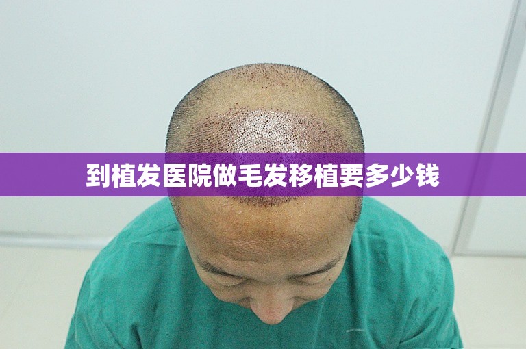 到植发医院做毛发移植要多少钱