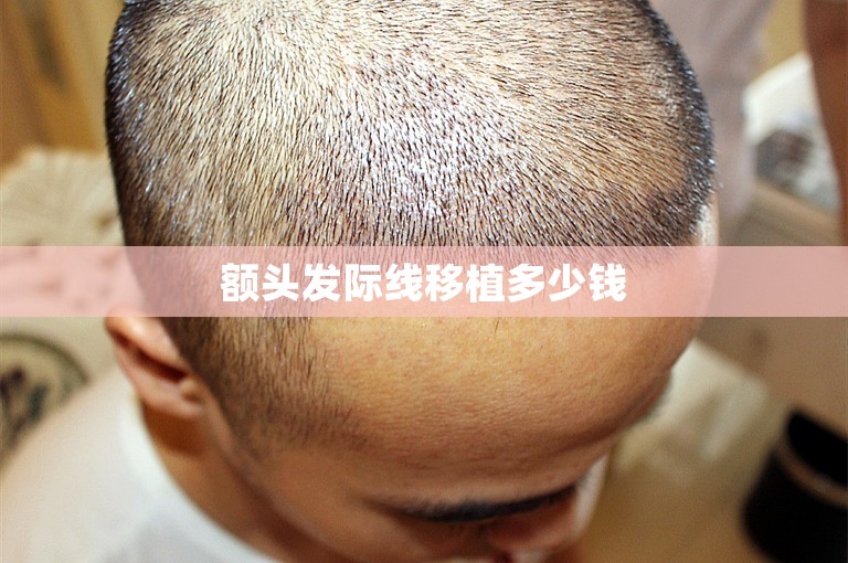 额头发际线移植多少钱 额头发际线移植多少钱