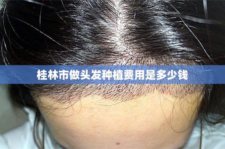 桂林市做头发种植费用是多少钱