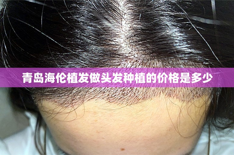 青岛海伦植发做头发种植的价格是多少