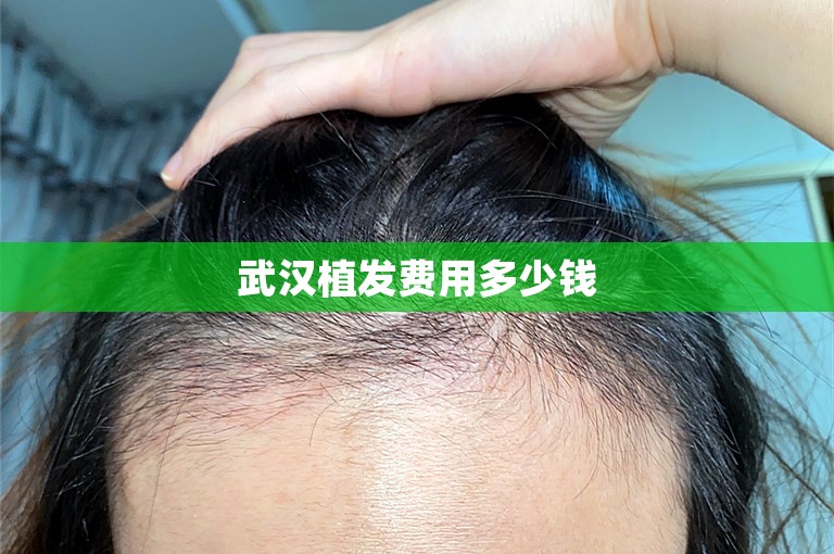 武汉植发费用多少钱
