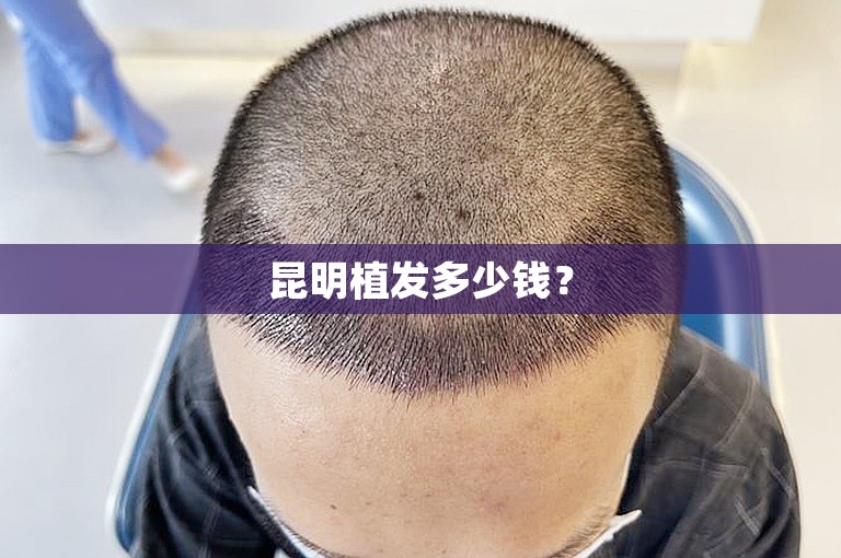 昆明植发多少钱？