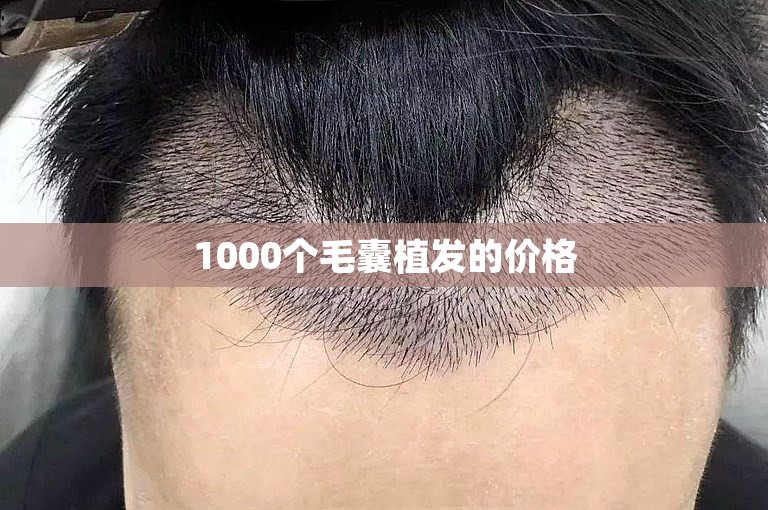 1000个毛囊植发的价格 1000个毛囊植发的价格