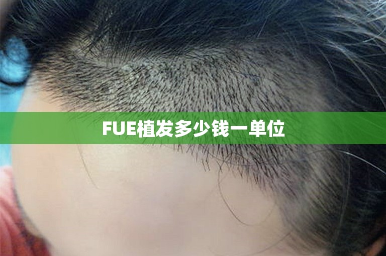 FUE植发多少钱一单位 FUE植发多少钱一单位