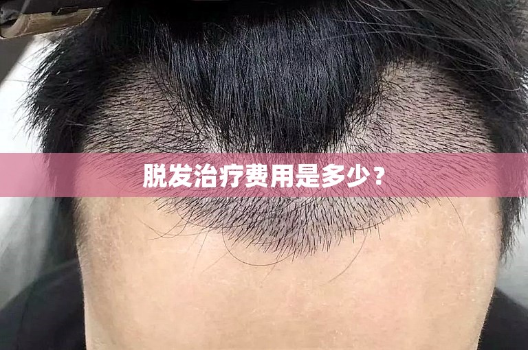 脱发治疗费用是多少？