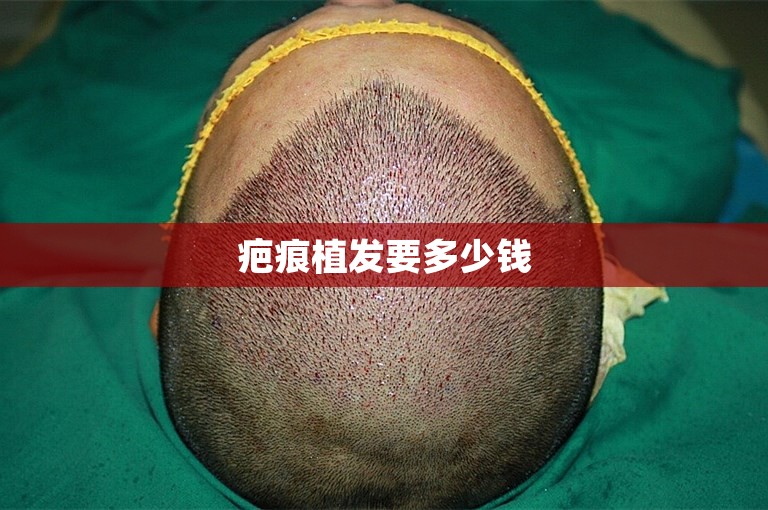 疤痕植发要多少钱