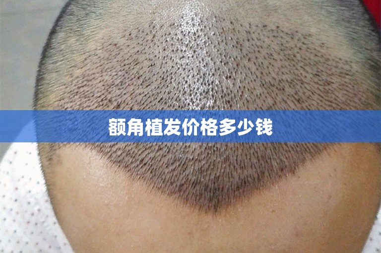 额角植发价格多少钱