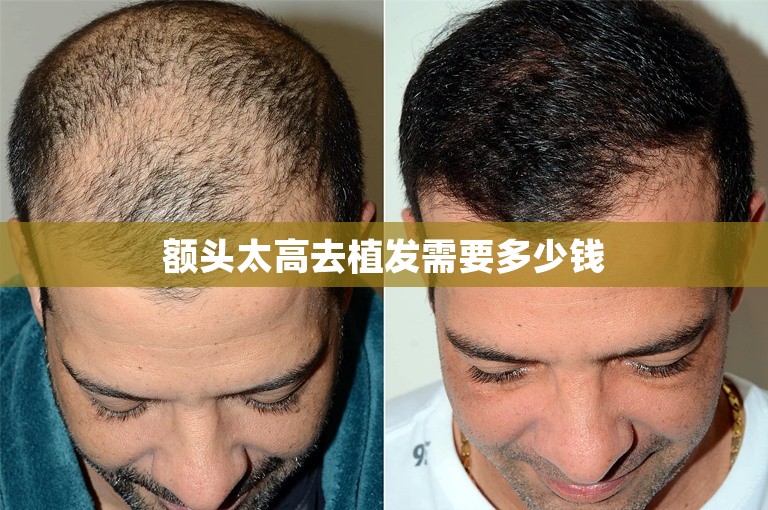 额头太高去植发需要多少钱 额头太高去植发需要多少钱