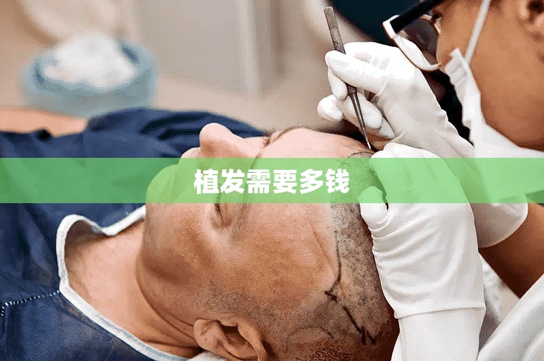 植发需要多钱