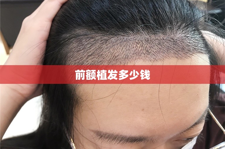 前额植发多少钱