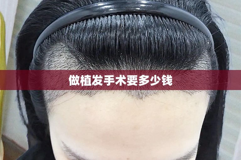 做植发手术要多少钱