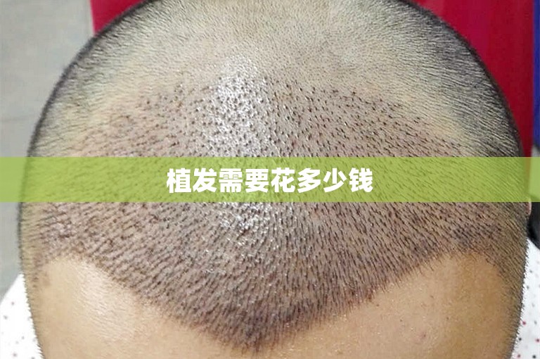 植发需要花多少钱