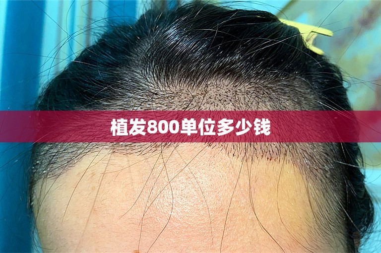 植发800单位多少钱