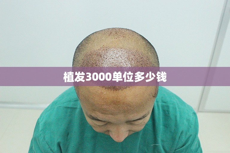 植发3000单位多少钱