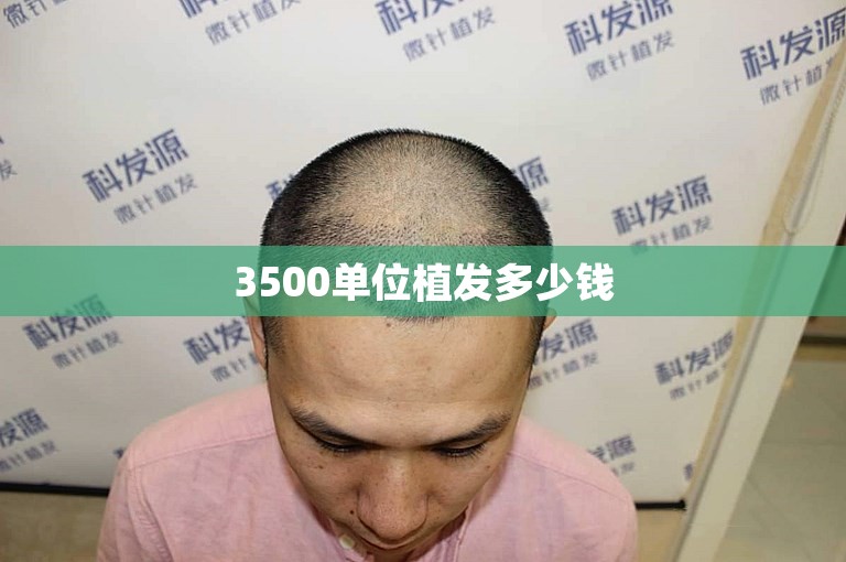 3500单位植发多少钱 3500单位植发多少钱