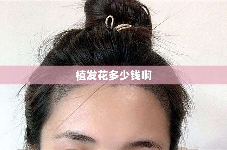植发花多少钱啊