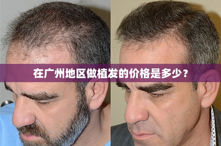 在广州地区做植发的价格是多少？