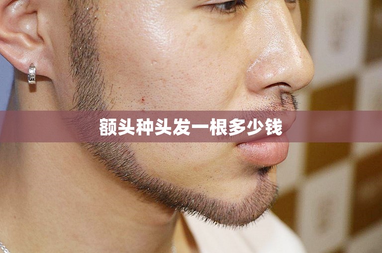 额头种头发一根多少钱 额头种头发一根多少钱