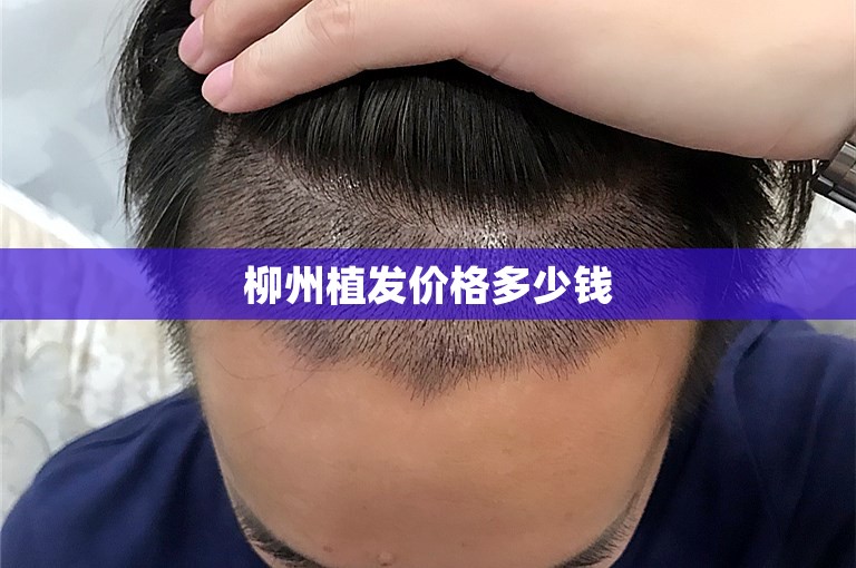 柳州植发价格多少钱