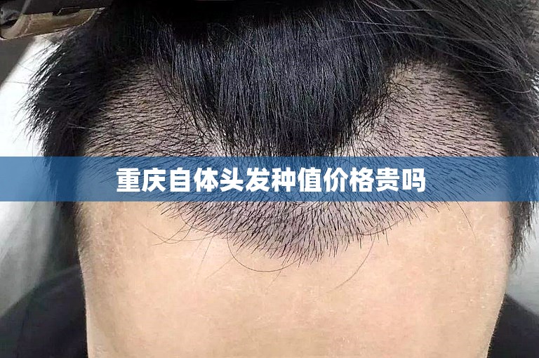 重庆自体头发种值价格贵吗