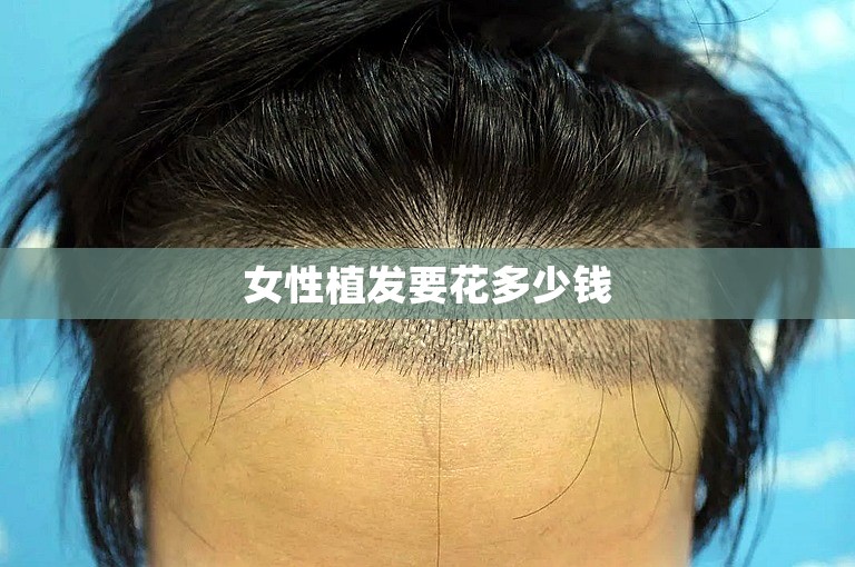 女性植发要花多少钱