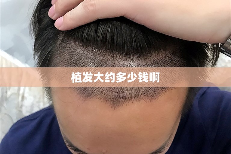 植发大约多少钱啊