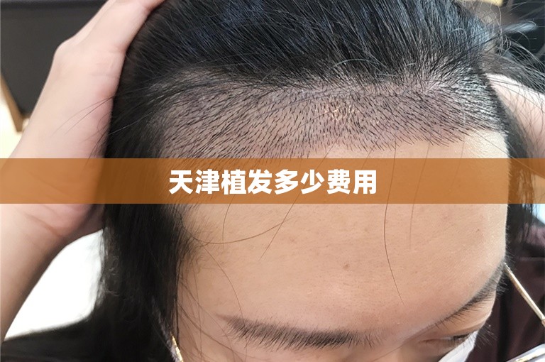 天津植发多少费用