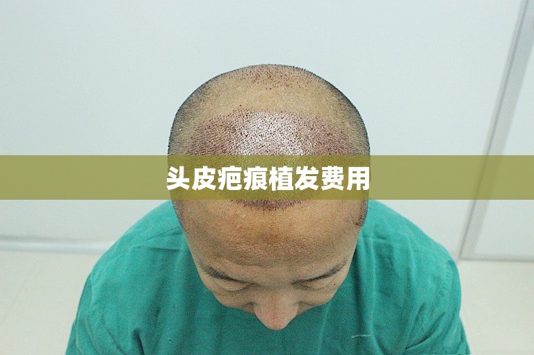 头皮疤痕植发费用