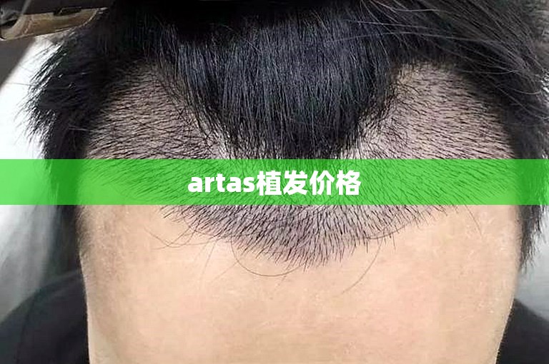 artas植发价格 artas植发价格