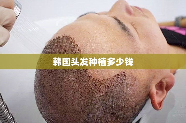 韩国头发种植多少钱 韩国头发种植多少钱