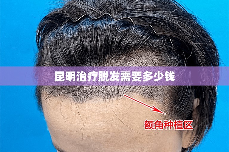昆明治疗脱发需要多少钱