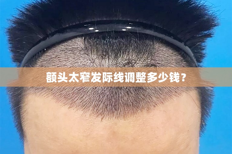 额头太窄发际线调整多少钱? 额头太窄发际线调整多少钱?