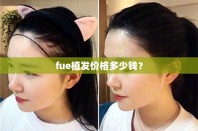 fue植发价格多少钱? fue植发价格多少钱?