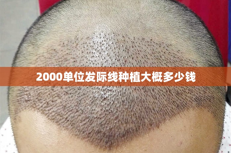 2000单位发际线种植大概多少钱